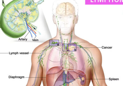 Best Lymphoma Care and Treatment in Gurgaon