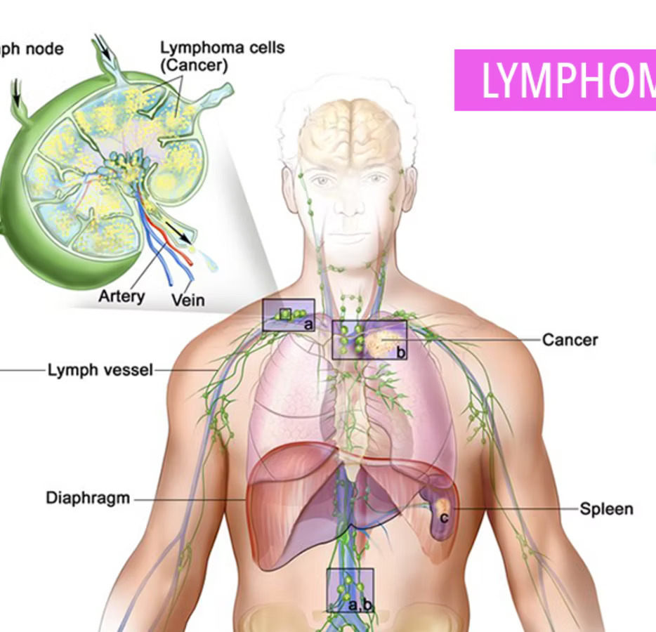 Best Lymphoma Care and Treatment in Gurgaon